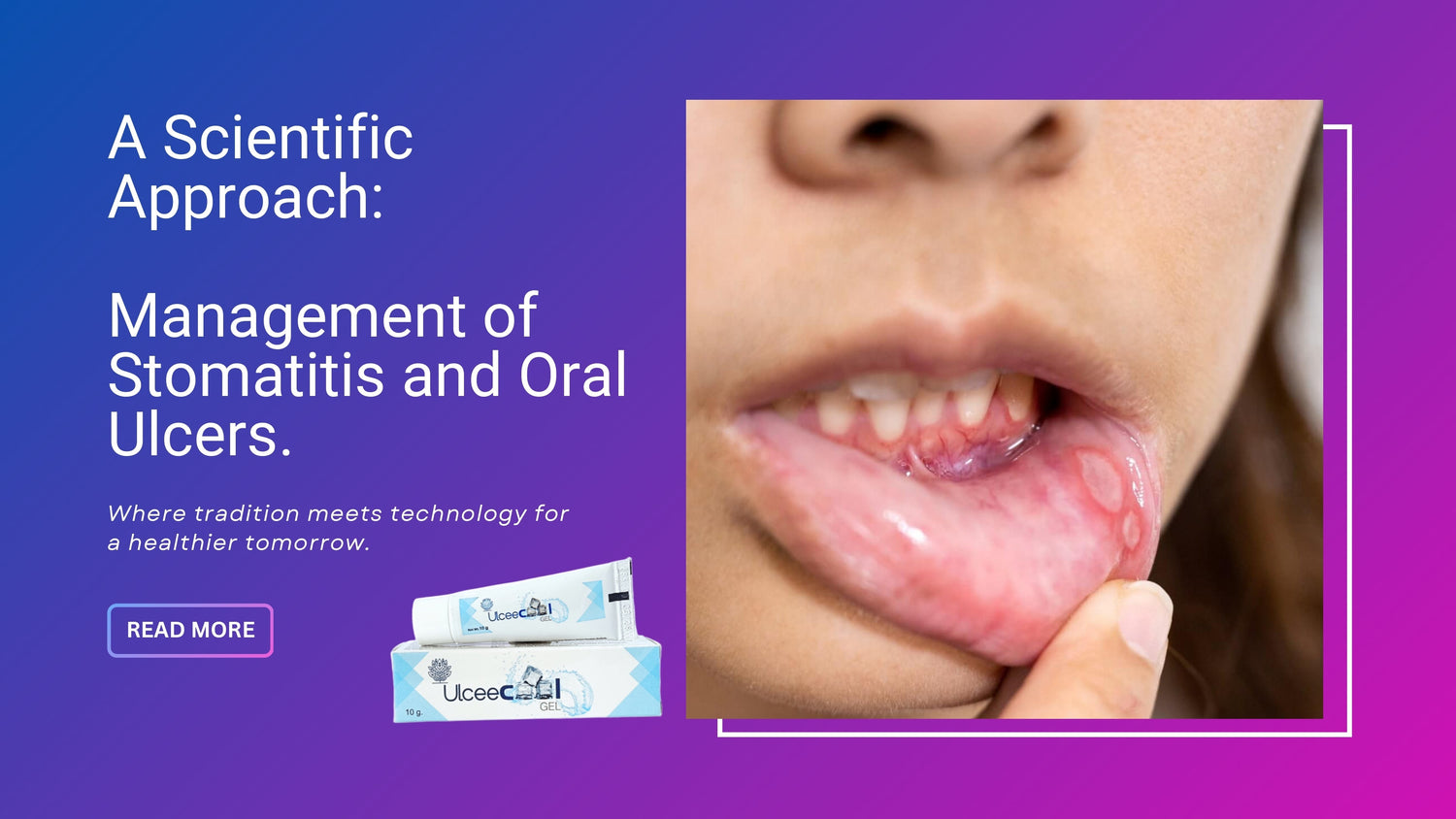 A Scientific Approach: Management of Stomatitis and Oral Ulcers.